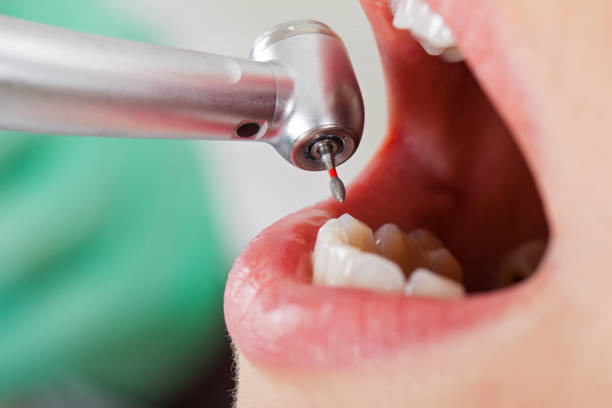 Best Broken or Chipped Tooth Repair in Nutter Fort, WV